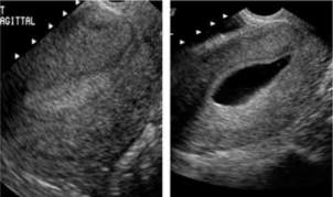 uter-hysterosono-norm[1]